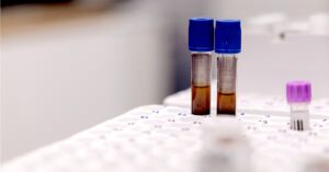 Может ли анемия увеличить риск развития деменции?